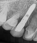 Fig 21 and Fig 22. Radiographs of final postoperative crowns, at 5 and 4 years.
