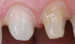 Finalized full-crown preparations on teeth Nos. 8 and 9.