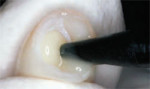 Injection of luting agent into one of the ceramic crowns.