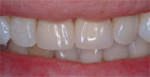 Seating and cementation of the full-crown ceramic restorations.
