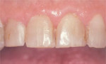 Close up of worn, discolored anterior teeth with poor restorations.