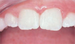 The same central incisor properly restored with composite.