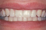 The same smile 7 years after composite restoration.