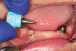 Fig. 3. Definitive overdenture abutments (LOCATOR R-Tx, Zest Dental Solutions) were placed onto each implant and torqued according to the manufacturer’s recommended torque values.