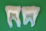 Figure 1  Tissue-specific tooth repair concept exemplified with mesiodistal cross sections. Resin-modified glass-ionomer liner/base was placed in the molar on the right.