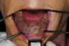 Figure 1  Use of gingival protector during the finishing of a cervical restoration to prevent trauma to the gingiva.