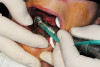 Figure 2  Caries extending cervically on upper right incisors.