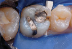 Figure 2  Mesio-occlusal and occlusolingual repair required in 29-year-old woman.