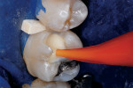 Figure 4  Resin-modified glass-ionomer injected, spread, and light-polymerized, after calcium hydroxide coverage.