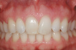 Figure 1  A minor overlap case involving all maxillary incisors.