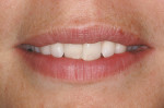 Figure 2  A minor overlap case involving all maxillary incisors.