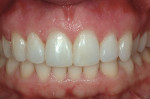 Figure 4  Realignment was achieved by resin additions to the mesial-lingual-incisal surfaces of all three teeth, with facial additions to tooth No. 8 and the distal of tooth No. 9.