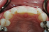 Figure 14  A properly positioned implant. Note the tissue contour established from the provisional restoration.