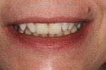 Figure 8  A patient presented with teeth Nos. 8 and 9 in strong lingual version with a mesiofacial rotation and overlap involving teeth Nos. 6, 7, and 10.