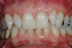 Figure 9  Reduction of the teeth involved primarily enamel and included the distalproximal surfaces of the maxillary central incisors and the mesio-facial surfaces of teeth Nos. 7 and 10.