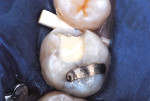 Figure 5  Dentin replacement base completed.