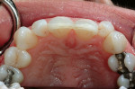 Figure 10  Reduction of the teeth involved primarily enamel and included the distalproximal surfaces of the maxillary central incisors and the mesio-facial surfaces of teeth Nos. 7 and 10.
