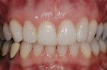 Figure 11  Restoration was achieved with the body shade of a nanofilled resin by thickening of the incisal edges of teeth Nos. 8 and 9 and adding to the distal-facial of tooth No. 7 and to the mesial-lingual of teeth Nos. 6, 7, and 10.