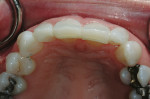 Figure 12  Restoration was achieved with the body shade of a nanofilled resin by thickening of the incisal edges of teeth Nos. 8 and 9 and adding to the distal-facial of tooth No. 7 and to the mesial-lingual of teeth Nos. 6, 7, and 10.