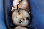 Figure 6  Resin-based composite enamel replacement bonded into place in layers.