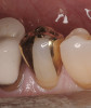 Figure 6  Disinfection of dental impressions by immersion before laboratory processing.