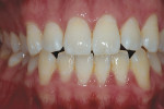 Figure 7  White spots occasionally go through a “splotchy stage,” which occurs in the first few days of bleaching when the white areas respond quicker than normal enamel.