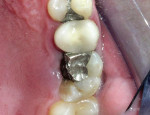 Figure 1  Preoperative clinical photograph of the fractured lingual cusps with the redundant gingival tissue.