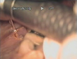 Figure 3  Removal and recontouring of the gingival tissue with the Er,Cr:YSGG tip in near contact.