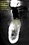 Fig 12. CBCT scan 24 weeks after regeneration with tenting screws.