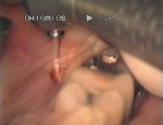 Figure 4  Removal and reduction of the osseous crest with the Er,Cr:YSGG laser.