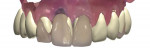 Fig 9 and Fig 10. A virtual diagnostic wax-up for the restoration design was done replicating the patient’s previous restoration per the patient’s request; frontal view (Fig 9), occlusal view (Fig 10). The white areas represent improved design.
