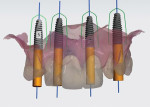 Fig 11 and Fig 12. The CBCT and virtual wax-up plan were merged together, and virtual implant placement was done; frontal view (Fig 11), occlusal view (Fig 12).