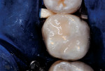 Figure 10  Completed tooth repair after occlusolingual stratified restoration.
