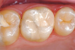 Figure 12  The restoration 26 months after initial treatment and renewed finishing using diamond burs, self-etching bonding agent, and clear resin sealant.