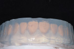Fig 12. A clear silicone matrix was fabricated in-office to facilitate an injection molding technique for the temporary restorations.