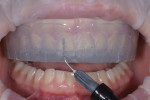 Fig 13. A bleach shade composite was injected into the seated matrix to create the temporary restorations.