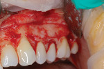 Fig 8. The desired free gingival margin was marked during surgery.