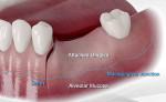 Fig 1. Recommended crestal incision with vertical releasing incision extending apical to the mucogingival line. (Illustration courtesy of Augma Biomaterials Ltd. Used with permission.)