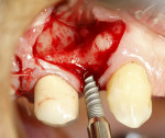 Fig 4. Implant placement in the first premolar edentulous space with noted buccal concavity apical to the superior aspect of the crest.