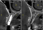 Fig 6. CBCT 4 months postoperatively demonstrating osseous fill by replacement of the calcium sulphate bone cement with host bone.