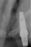 Fig 10. Radiograph following implant placement into the previous grafted anterior maxillary site.
