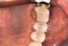 Figure 3  Erythroplakia of the left soft palate/tonsil complex.