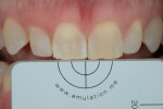 Fig 10. Photograph showing right central incisor 3 hours after rubber dam removal.