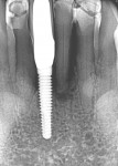 Fig 16. Periapical radiograph demonstrating periapical lesion on left central incisor adjacent to a previously placed and restored implant.