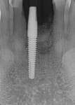 Fig 21. Periapical radiograph taken immediately post-extraction and autogenous dentin graft placement.