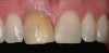 Figure 5  Absence of attached gingiva predisposes some patients to progressive recession (site No. 4).