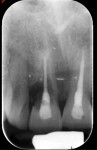 Fig 15. Preoperative radiograph of nonrestorable tooth No. 8.
