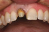 Figure 7  Absence of keratinized tissue often does not result in additional recession. Site No. 24 demonstrates recession at time of crown insertion (Fig 6). Fig 7 demonstrates that the tissue level has remained stable after 1 year. This patient had good oral hygiene.