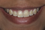 Fig 1. White spots were noticeable especially on the lateral incisors and the maxillary right central incisor.