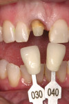 Figure 11  Photographs of the preparation should include a view with surrounding dentition, a close-up view of the preparation, and a view with shade tabs to provide a color reference.